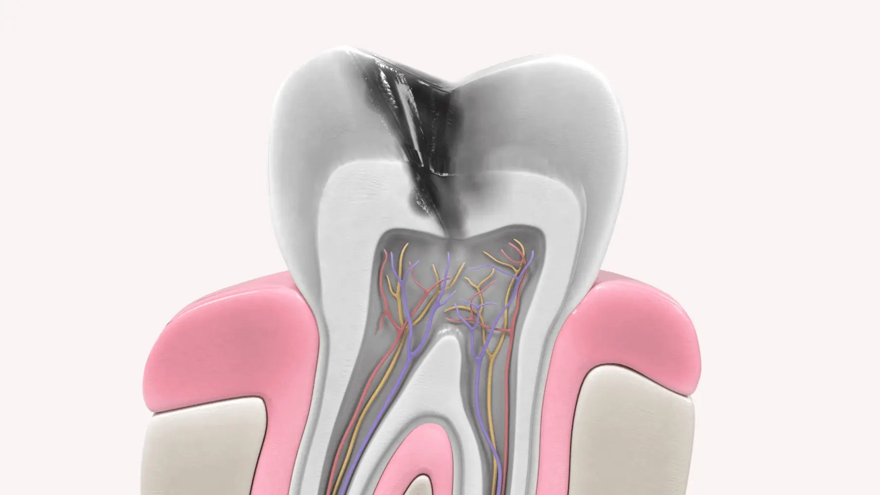 que es una endodoncia